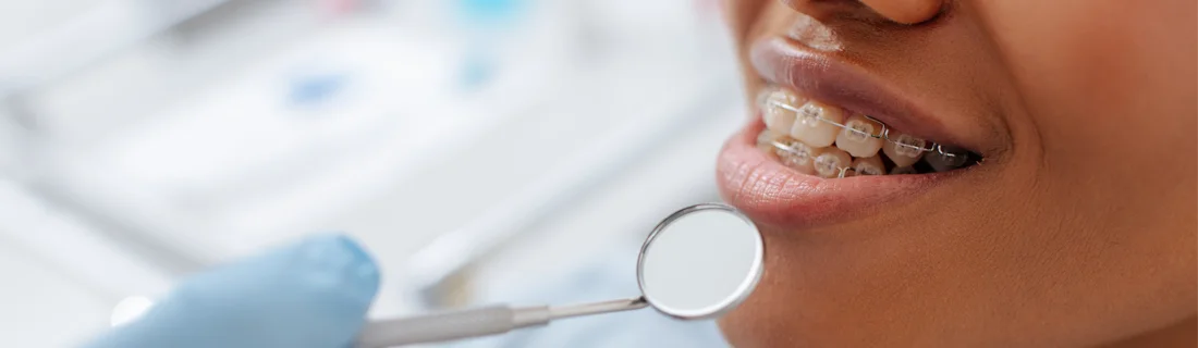 How to Brush Teeth With Braces in Thousand Oaks CA How to Brush Teeth With Braces in Thousand Oaks CA