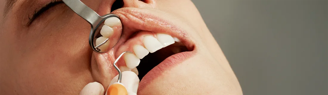 FC – Non-Surgical Gum Disease Treatment in Thousand Oaks, CA FC – Non-Surgical Gum Disease Treatment in Thousand Oaks, CA